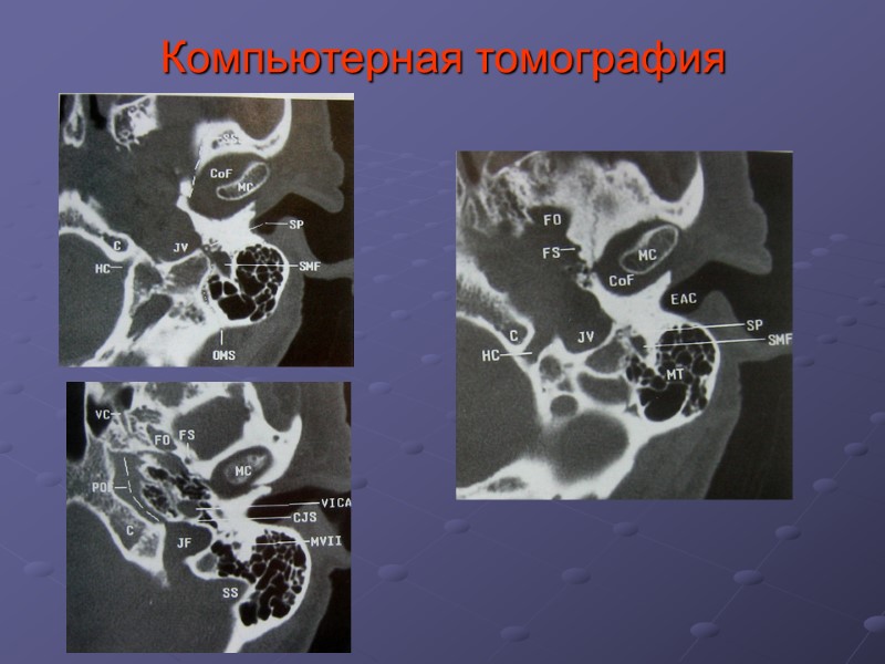 Компьютерная томография